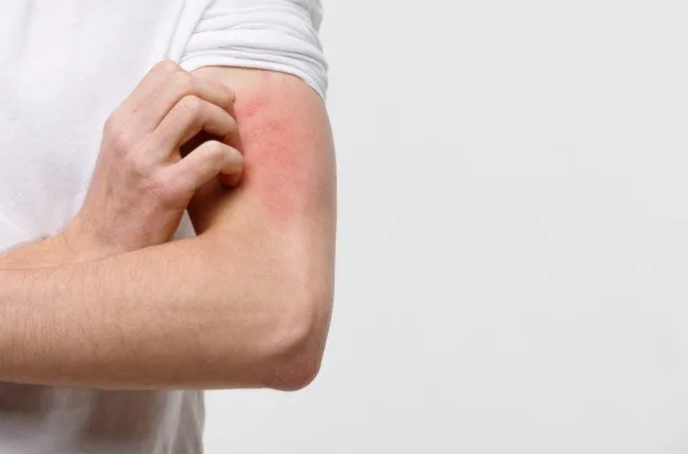 Hard water effects on skin